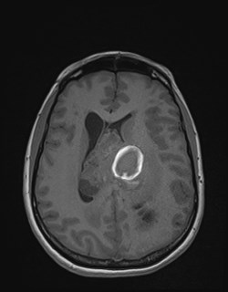 File:Central neurocytoma (Radiopaedia 84497-99872 Axial T1 123).jpg