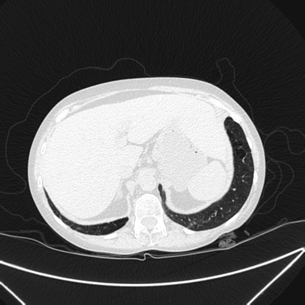 Centrilobular pulmonary emphysema (Radiopaedia 24495-24789 Axial lung window 86).jpg
