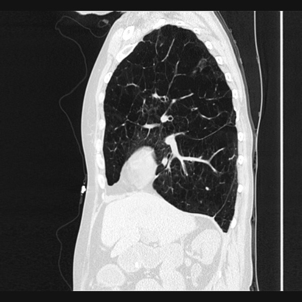 Centrilobular pulmonary emphysema (Radiopaedia 24495-24789 Sagittal lung window 30).jpg