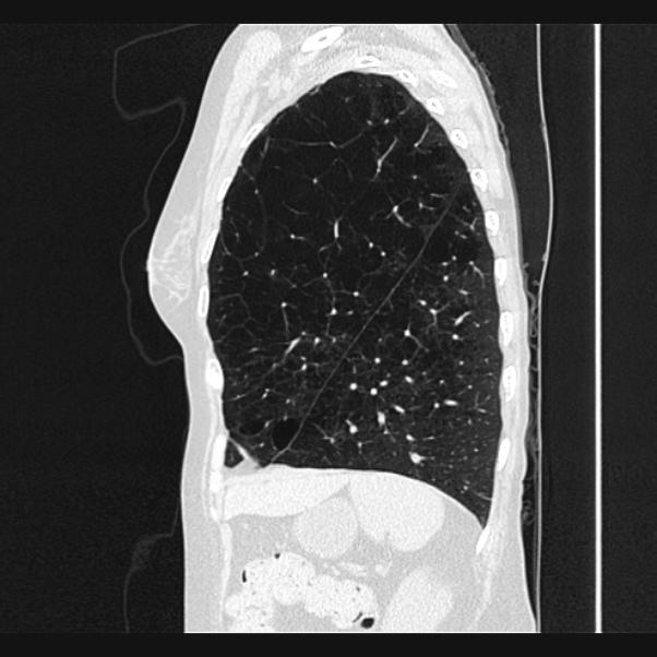 Centrilobular pulmonary emphysema (Radiopaedia 24495-24789 Sagittal lung window 67).jpg