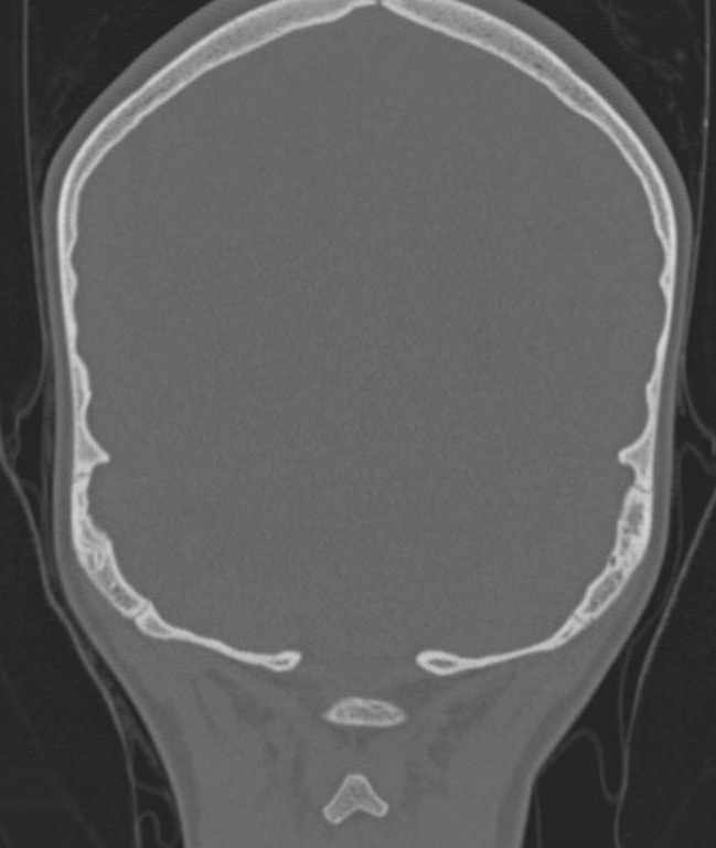 Cerebellar abscess (Radiopaedia 73727-84527 Coronal bone window 3).jpg