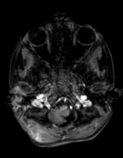 Cerebellar abscess (Radiopaedia 73727-84563 Axial T1 C+ fat sat 36).jpg