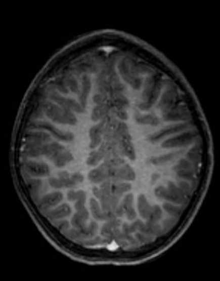 Cerebellar abscess (Radiopaedia 73727-84563 Axial T1 C+ fat sat 82).jpg