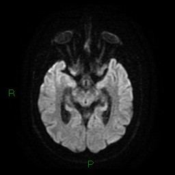 Cerebellar abscess (Radiopaedia 78135-90678 Axial DWI 14).jpg
