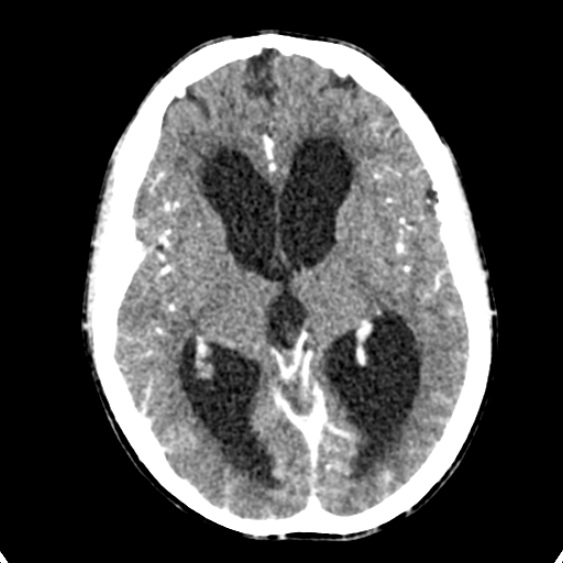 Cerebellar abscess secondary to mastoiditis (Radiopaedia 26284-26412 Axial C+ delayed 78).jpg