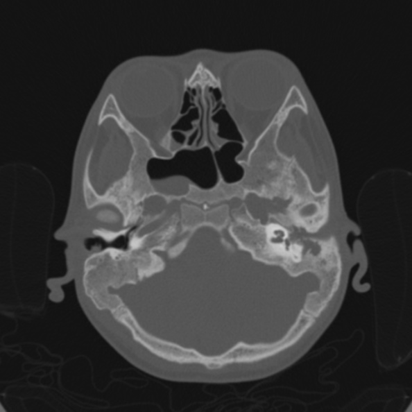 Cerebellar abscess secondary to mastoiditis (Radiopaedia 26284-26413 Axial bone window 46).jpg
