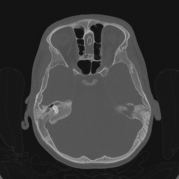 Cerebellar abscess secondary to mastoiditis (Radiopaedia 26284-26413 Axial bone window 68).jpg