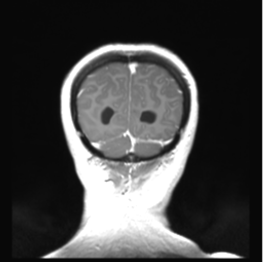 Cerebellar ependymoma complicated by post-operative subdural hematoma (Radiopaedia 83322-97736 Coronal T1 C+ 51).png