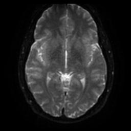 Cerebellar hemangioblastoma (Radiopaedia 29570-30077 Axial DWI 39).jpg