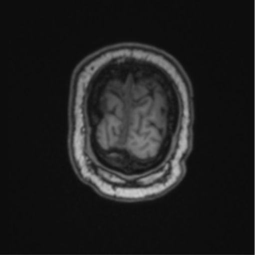 File:Cerebellar hemangioblastomas and pituitary adenoma (Radiopaedia 85490-101176 Coronal T1 12).png