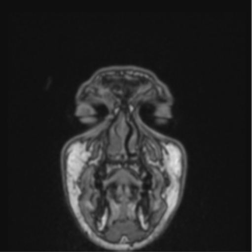 File:Cerebellar hemangioblastomas and pituitary adenoma (Radiopaedia 85490-101176 Coronal T1 89).png