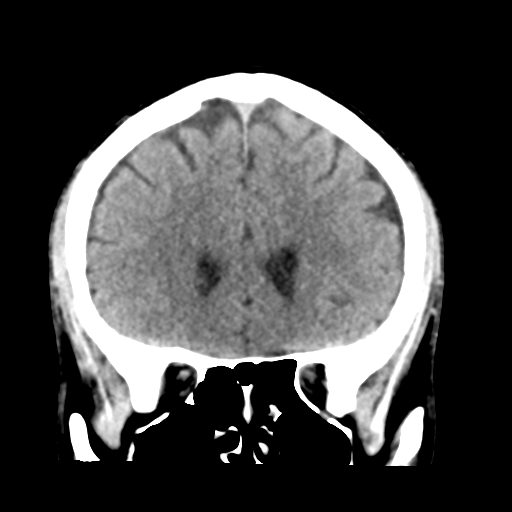 File:Cerebellar hemorrhage (Radiopaedia 37000-38669 Coronal non-contrast 15).png