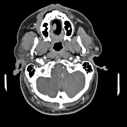 Cerebellar infarct due to vertebral artery dissection with posterior fossa decompression (Radiopaedia 82779-97029 C 42).png