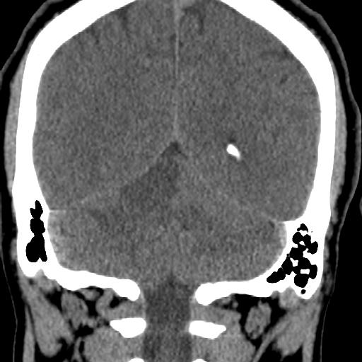 File:Cerebellar infarction (Radiopaedia 16625-16327 Coronal non-contrast 26).jpg