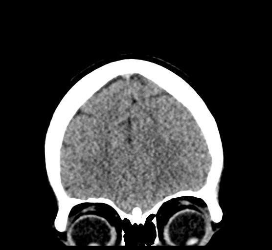 File:Cerebellar metastases - colorectal adenocarcinoma (Radiopaedia 40947-43652 Coronal non-contrast 23).png