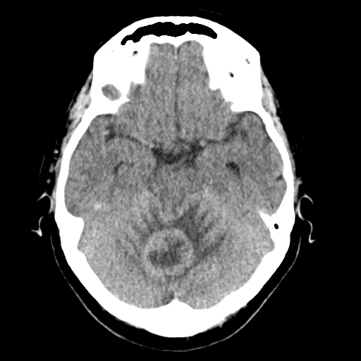 Cerebellar metastasis (Radiopaedia 54578-60812 Axial non-contrast 17).png