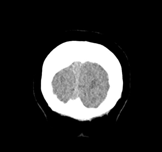 Cerebellar metastasis (Radiopaedia 54578-60812 Coronal non-contrast 58).png