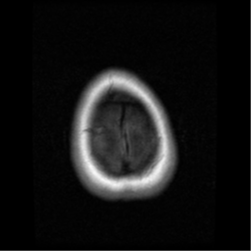 File:Cerebellar metastasis (cystic appearance) (Radiopaedia 41395-44262 Axial T1 22).png