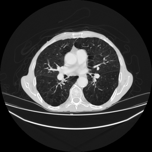 File:Cerebellar metastasis - lung tumor (Radiopaedia 69317-79150 Axial lung window 18).jpg