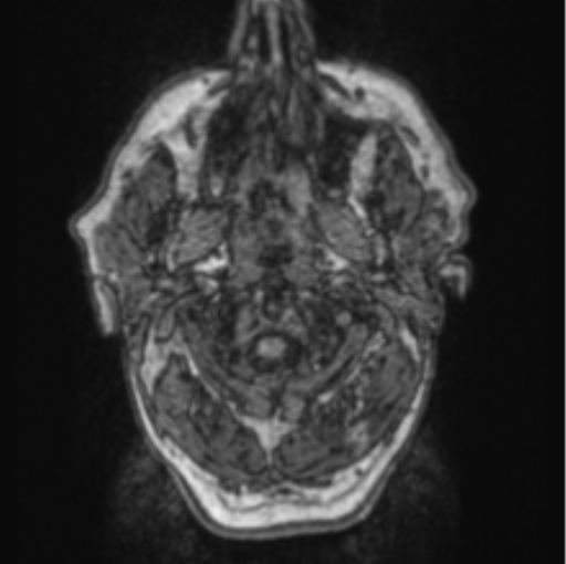 Cerebellar metastasis from lung adenocarcinoma (Radiopaedia 86690-102829 Axial T1 1).png