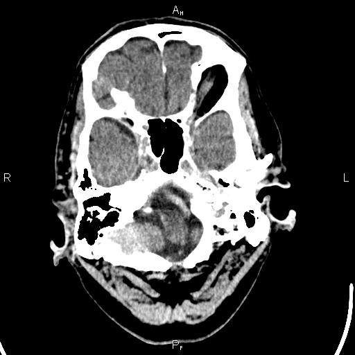 Cerebellopontine angle arachnoid cyst (Radiopaedia 85149-100704 Axial With contrast 6).jpg
