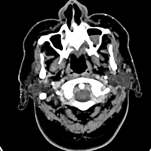 Cerebellopontine angle meningioma (Radiopaedia 35181-36714 A 65).jpg