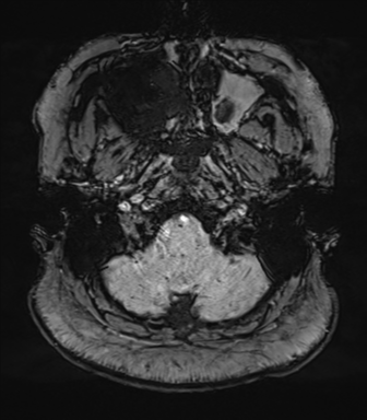 Cerebellopontine angle meningioma (Radiopaedia 48434-53348 Axial SWI 11).png