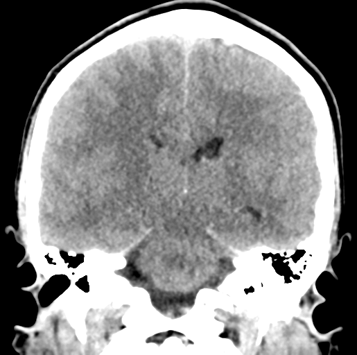 Cerebral abscess (Radiopaedia 60342-68008 Coronal non-contrast 37).png