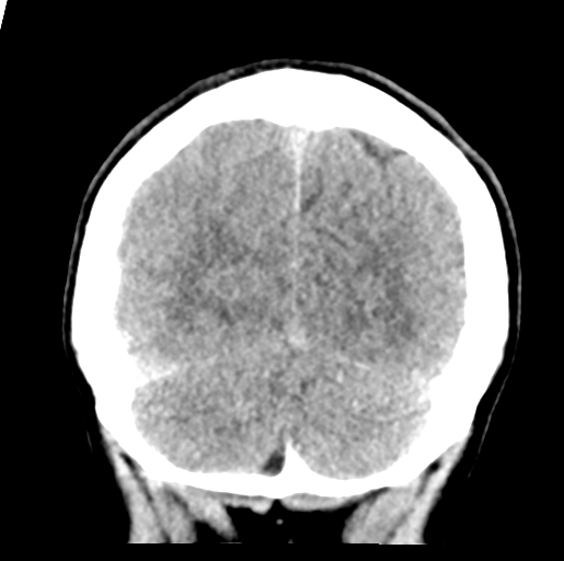 File:Cerebral abscess (Radiopaedia 60342-68008 Coronal non-contrast 53).png