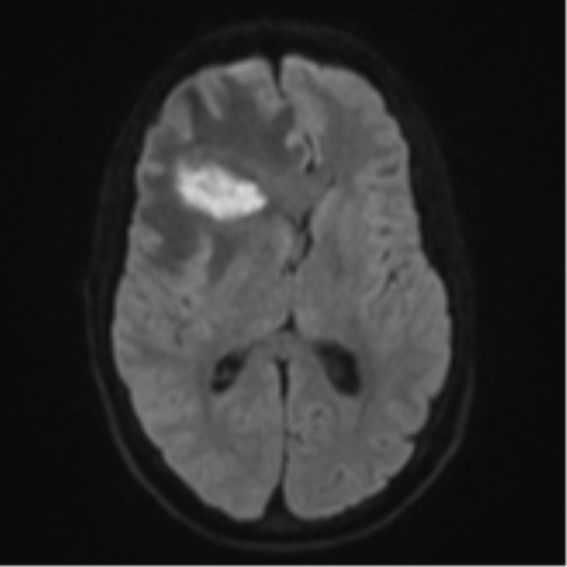 Cerebral abscess (Radiopaedia 60342-68009 Axial DWI 55).png