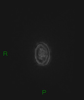 Cerebral abscess and subdural empyema (Radiopaedia 84436-99779 Axial FLAIR 3).jpg