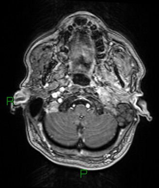 Cerebral abscess and subdural empyema (Radiopaedia 84436-99779 Axial T1 C+ 76).jpg