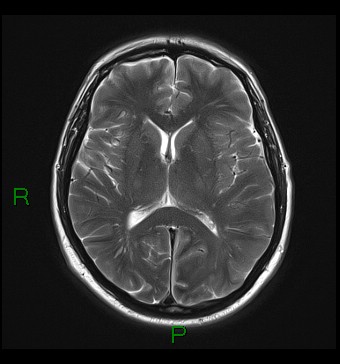 File:Cerebral abscess and subdural empyema (Radiopaedia 84436-99779 Axial T2 14).jpg