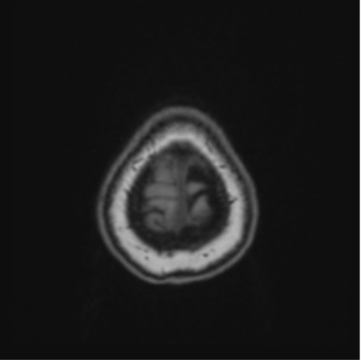 Cerebral abscess from pulmonary arteriovenous malformation (Radiopaedia 86275-102291 Axial T1 71).png