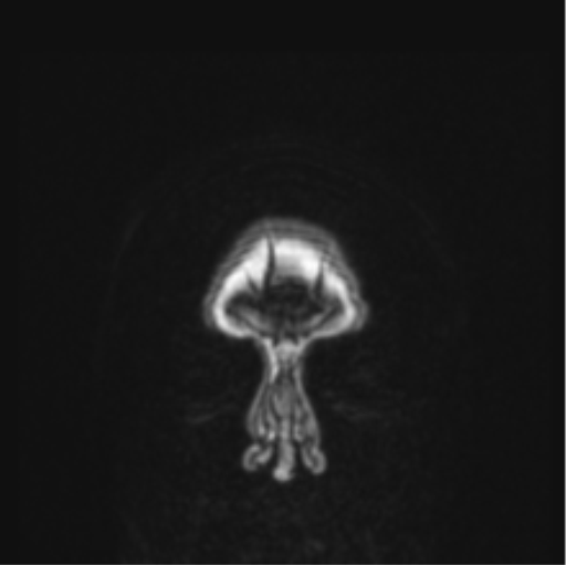 File:Cerebral abscess from pulmonary arteriovenous malformation (Radiopaedia 86275-102291 Coronal T1 90).png