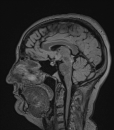 Cerebral abscess from pulmonary arteriovenous malformation (Radiopaedia 86275-102291 Sagittal FLAIR 38).png