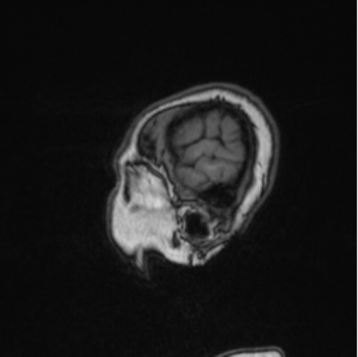 Cerebral abscess from pulmonary arteriovenous malformation (Radiopaedia 86275-102291 Sagittal T1 22).png