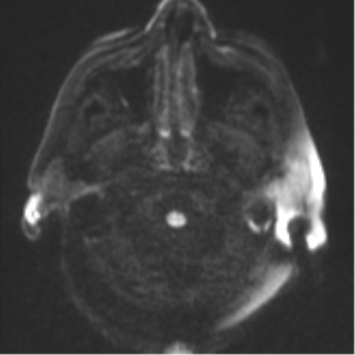 Cerebral abscesses- medically managed (Radiopaedia 45183-49179 Axial DWI 30).png
