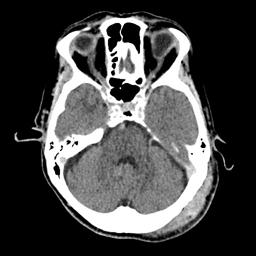 Cerebral amyloid angiopathy-related inflammation (Radiopaedia 74836-85848 Axial non-contrast 20).jpg