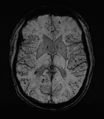 Cerebral amyloid angiopathy (Radiopaedia 46082-50433 Axial SWI MIP 41).png