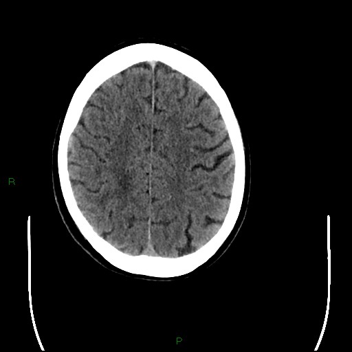 Cerebral amyloid angiopathy (Radiopaedia 77506-89665 Axial non-contrast 81).jpg