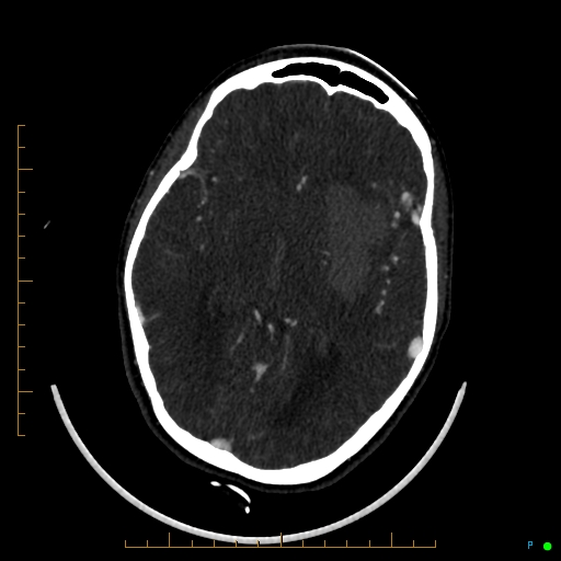 Cerebral arteriovenous malformation (AVM) (Radiopaedia 78162-90706 Axial CTA 136).jpg