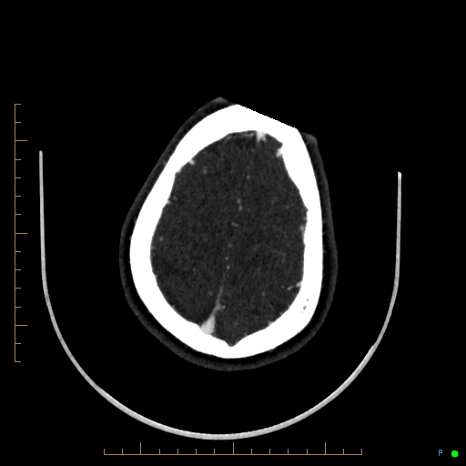 Cerebral arteriovenous malformation (AVM) (Radiopaedia 78162-90706 Axial CTA 233).jpg