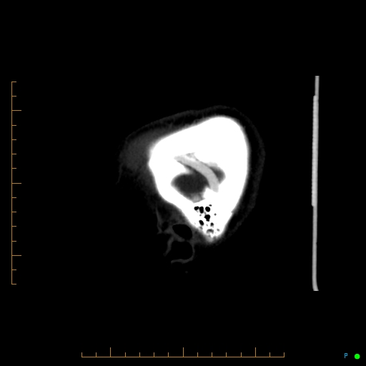 Cerebral arteriovenous malformation (AVM) (Radiopaedia 78162-90706 Sagittal CTA 8).jpg