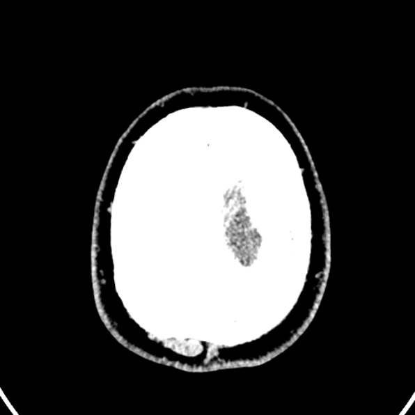 Cerebral arteriovenous malformation (Radiopaedia 37182-39012 Axial non-contrast 46).jpg