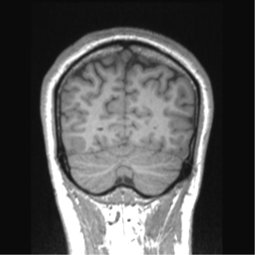 Cerebral arteriovenous malformation (Radiopaedia 39259-41506 Coronal T1 21).png