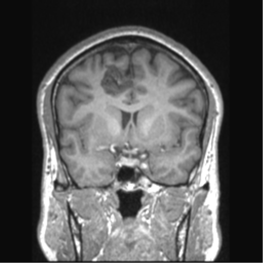 Cerebral arteriovenous malformation (Radiopaedia 39259-41506 Coronal T1 57).png
