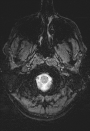 File:Cerebral arteriovenous malformation (Radiopaedia 55798-62372 Axial SWI 1).png