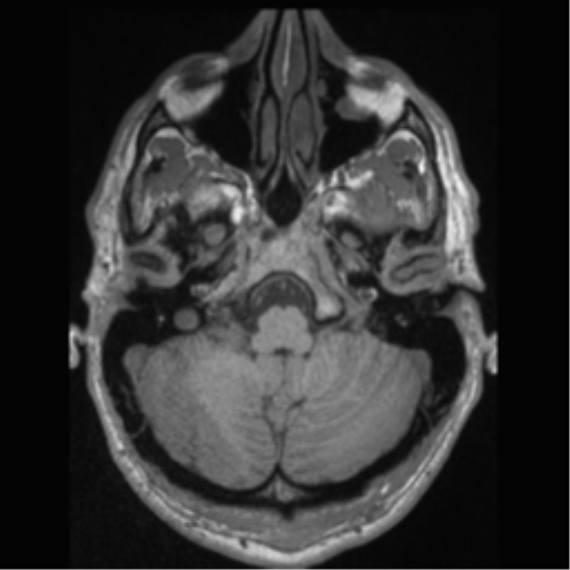 Cerebral arteriovenous malformation (Radiopaedia 55798-62372 Axial T1 9).png