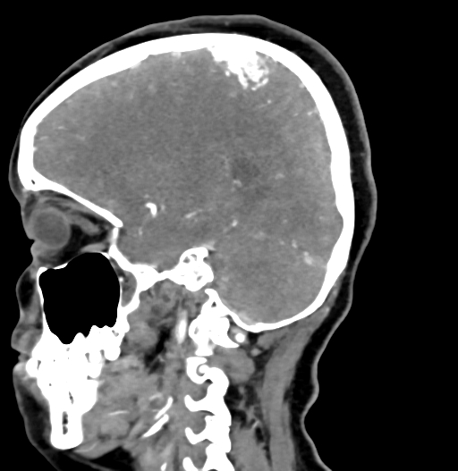 Cerebral arteriovenous malformation (Radiopaedia 73830-84645 D 61).jpg